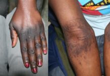 Cosmetic Skin Lightening Among Cameroonian Women: From a Social Trend to a Public Health Issue