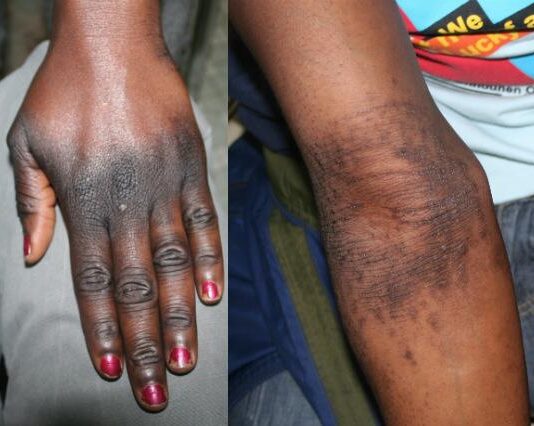 Cosmetic Skin Lightening Among Cameroonian Women: From a Social Trend to a Public Health Issue
